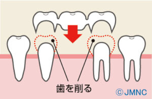 抜歯後両端にかぶせるブリッジ